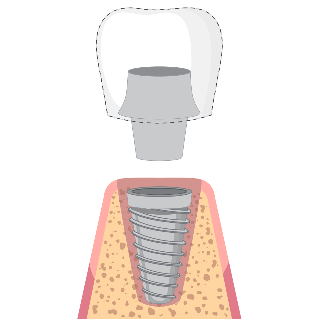 Implantology Process